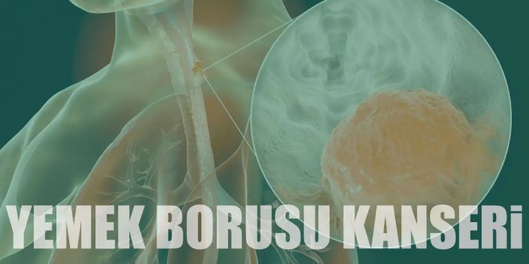 Yemek Borusu Kanseri Nedir Ve Belirtileri Nelerdir Tedavisi