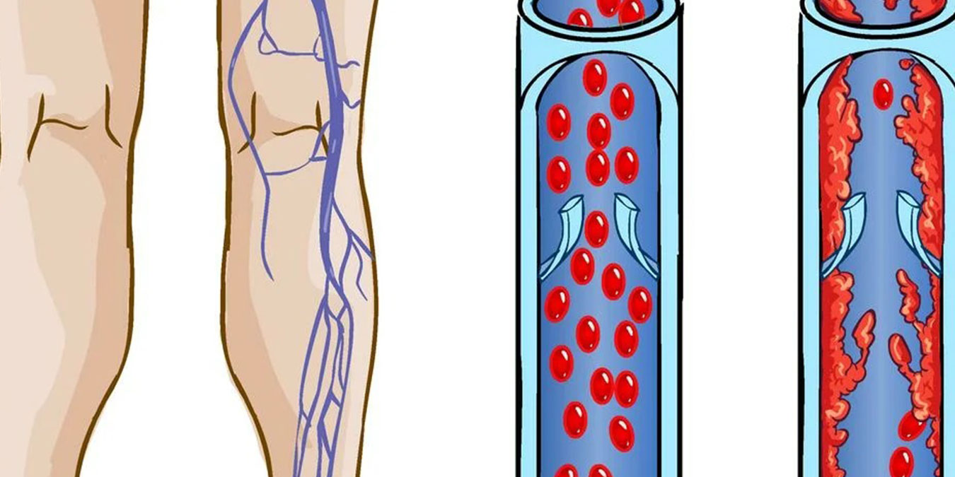 Ramazan’da Derin Ven Trombozu Hastaları İçin Dikkat Edilmesi Gerekenler!