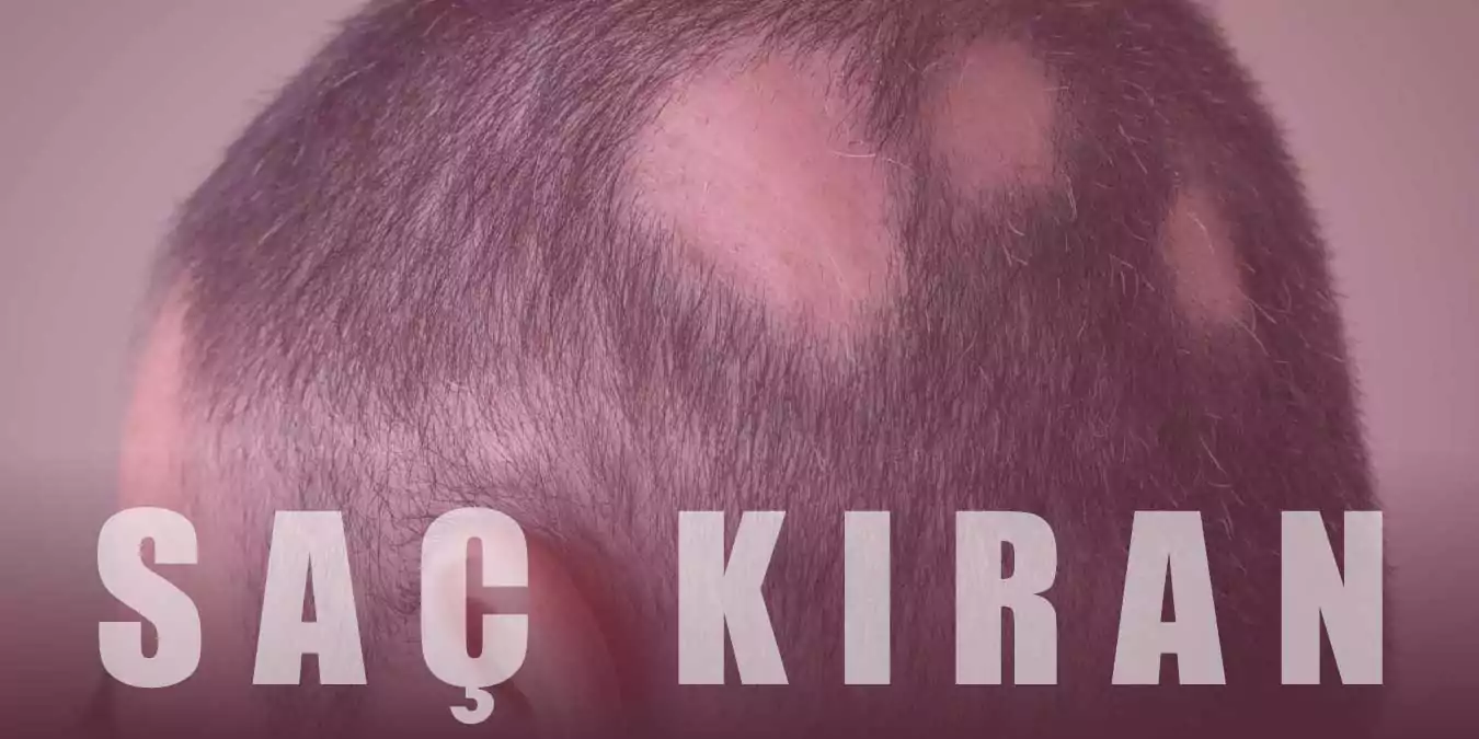 Saçkıran (Alopesi Areata) Nedir, Nasıl Tedavi Edilir? | Nedenleri ve Etkili Yöntemler