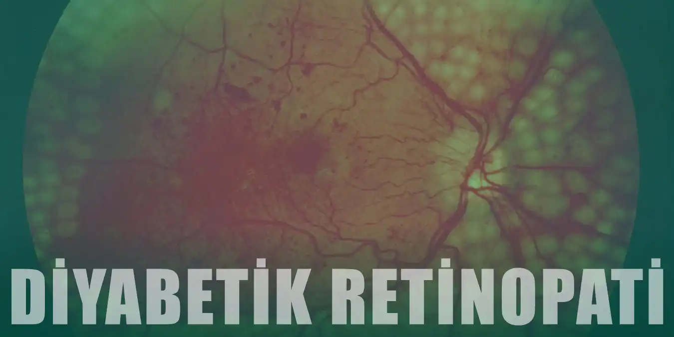 Diyabetik Retinopati Nedir, Belirtileri Nelerdir? Tedavisi