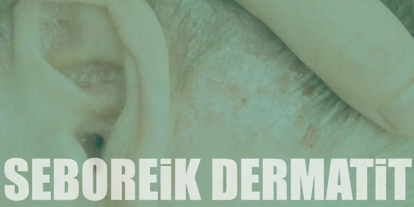 Seboreik Dermatit Nedir? Neden Olur ve Ne İyi Gelir?