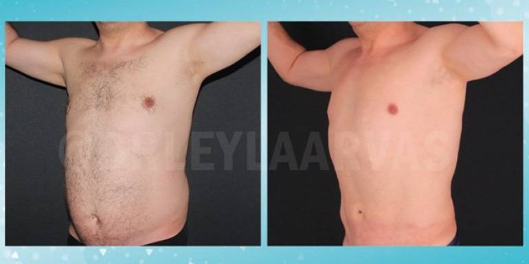 Liposuction Öncesi Yeni Bir Kontürünüze Kavuşmadan Bilmeniz Gerekenler!