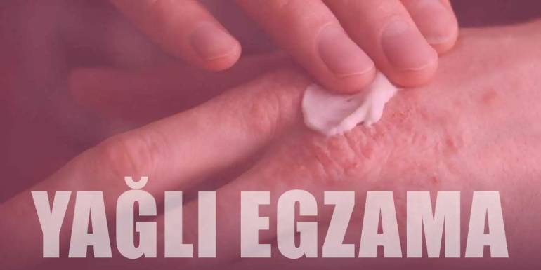 Yağlı Egzama Nedir? Belirtileri, Tedavi Yöntemleri ve Korunma Yolları