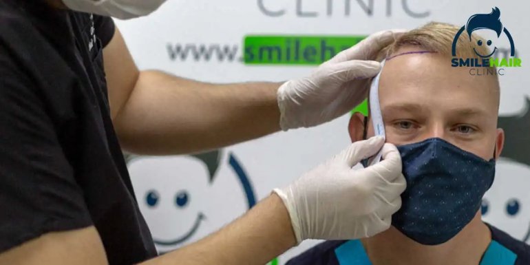 Saç Ekimi Yöntemleri - Smile Hair Clinic