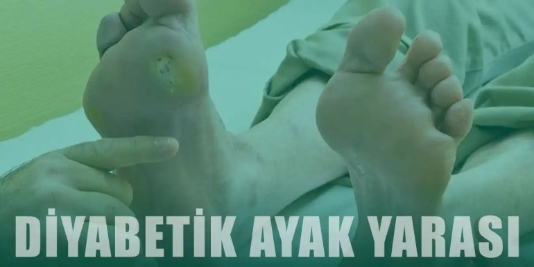 Diyabetik Ayak Yarası Nedir, Neden Olur? Tedavisi