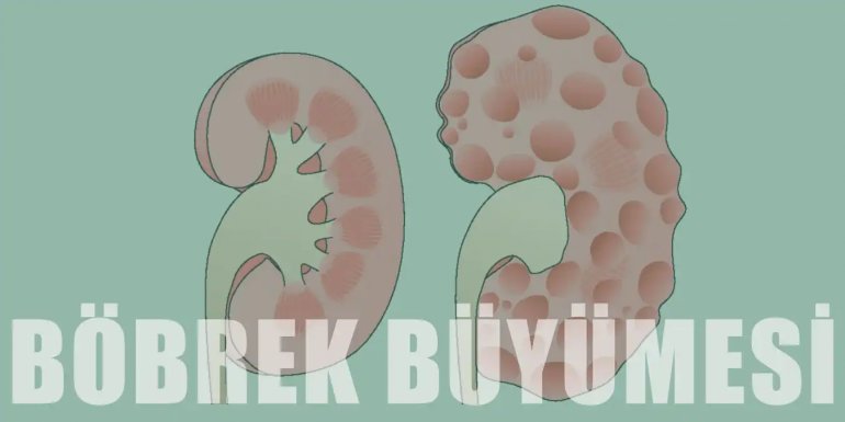 Böbrek Büyümesi Neden Olur? Belirtileri ve Ameliyatı