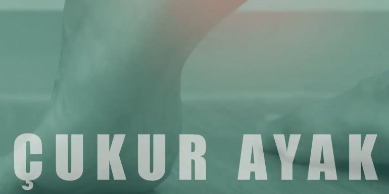 Çukur Ayak (Pes Kavus) Nedir ve Neden Olur?