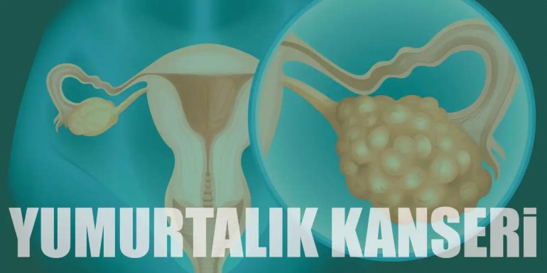 Yumurtalık Kanseri Nedir? Belirtileri ve Tedavi Yöntemleri