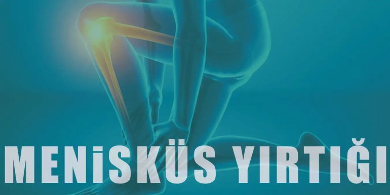 Menisküs Yırtığı Nedir? Neden Olur ve Nasıl Geçer?