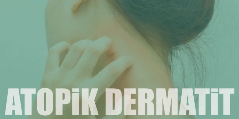 Atopik Dermatit Nedir? Egzama Belirtileri ve Tedavisi