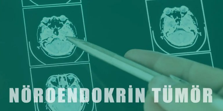 Nöroendokrin Tümör Nedir, Belirtileri ve Tedavisi Nelerdir?