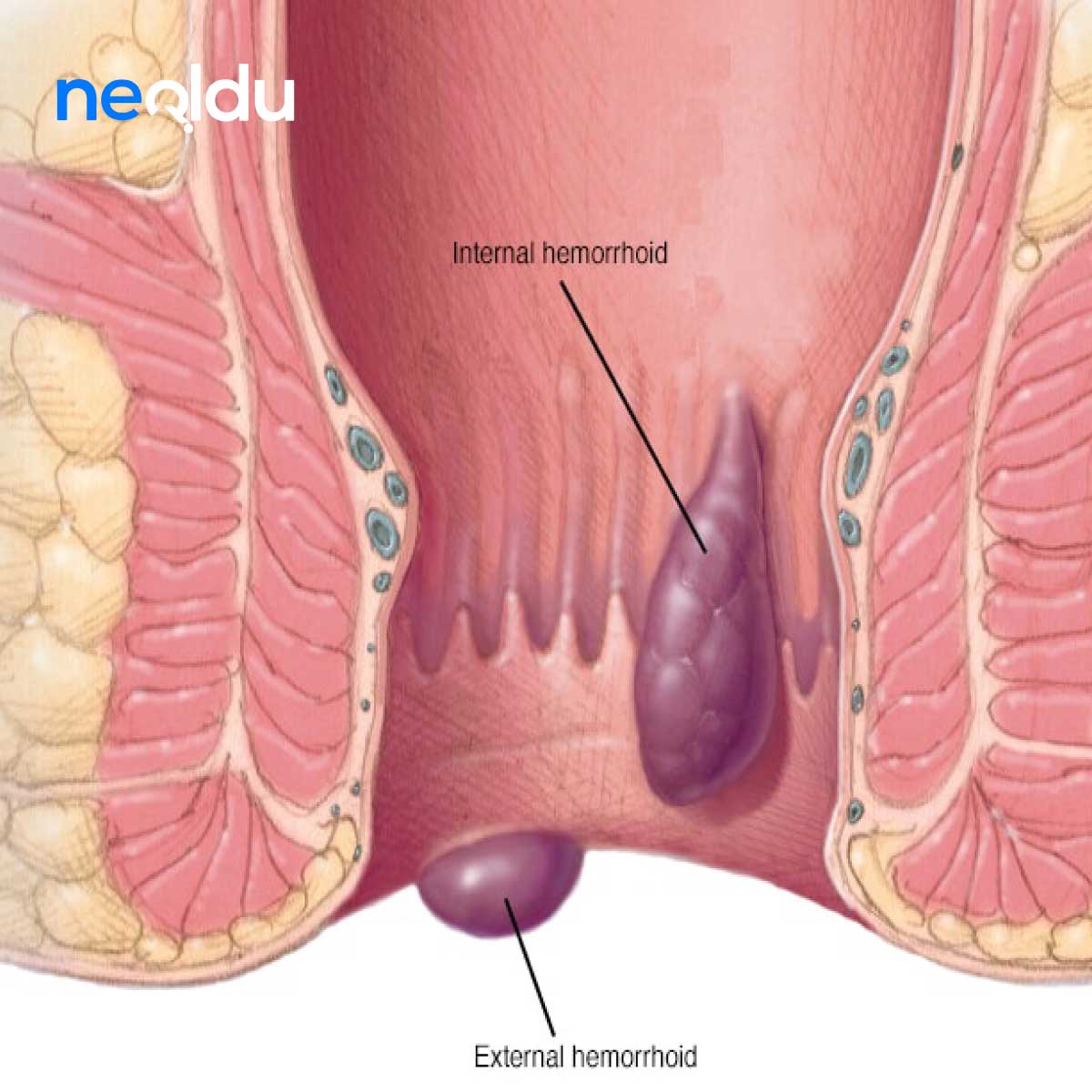 Hemoroid Dikkat Edilmesi Gerekenler