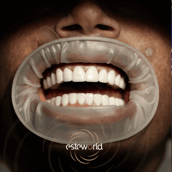 Diş Kaplaması Diş Kaplaması Nedir, Ne Zaman Tercih Edilir?