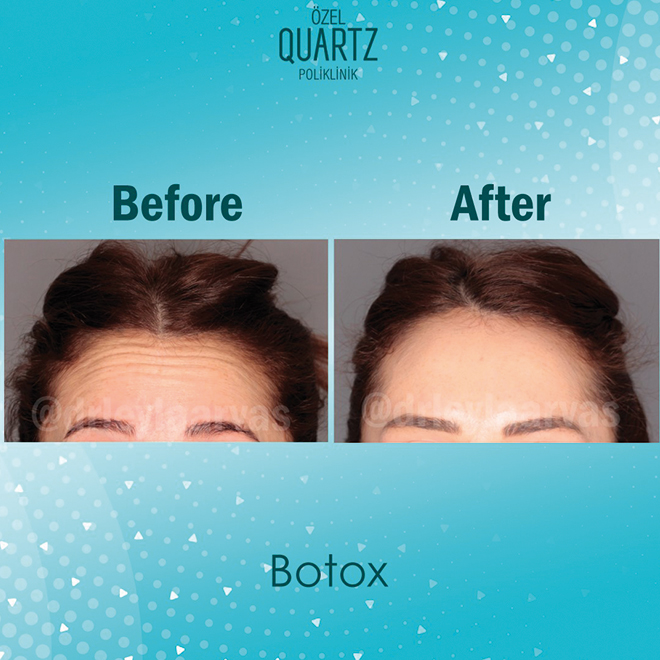 Botox Nerelere, Neden Yapılır