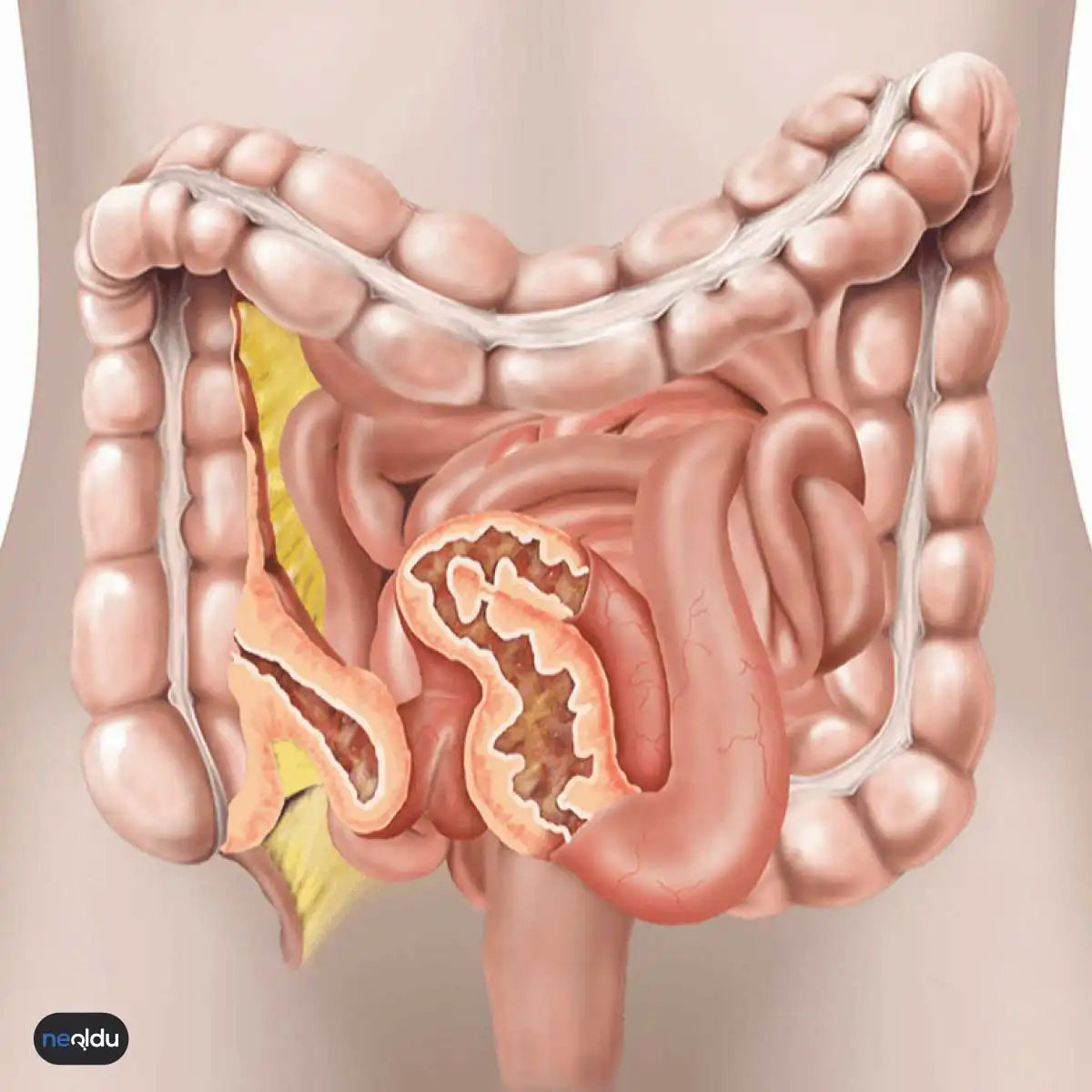 Crohn Hastalığı