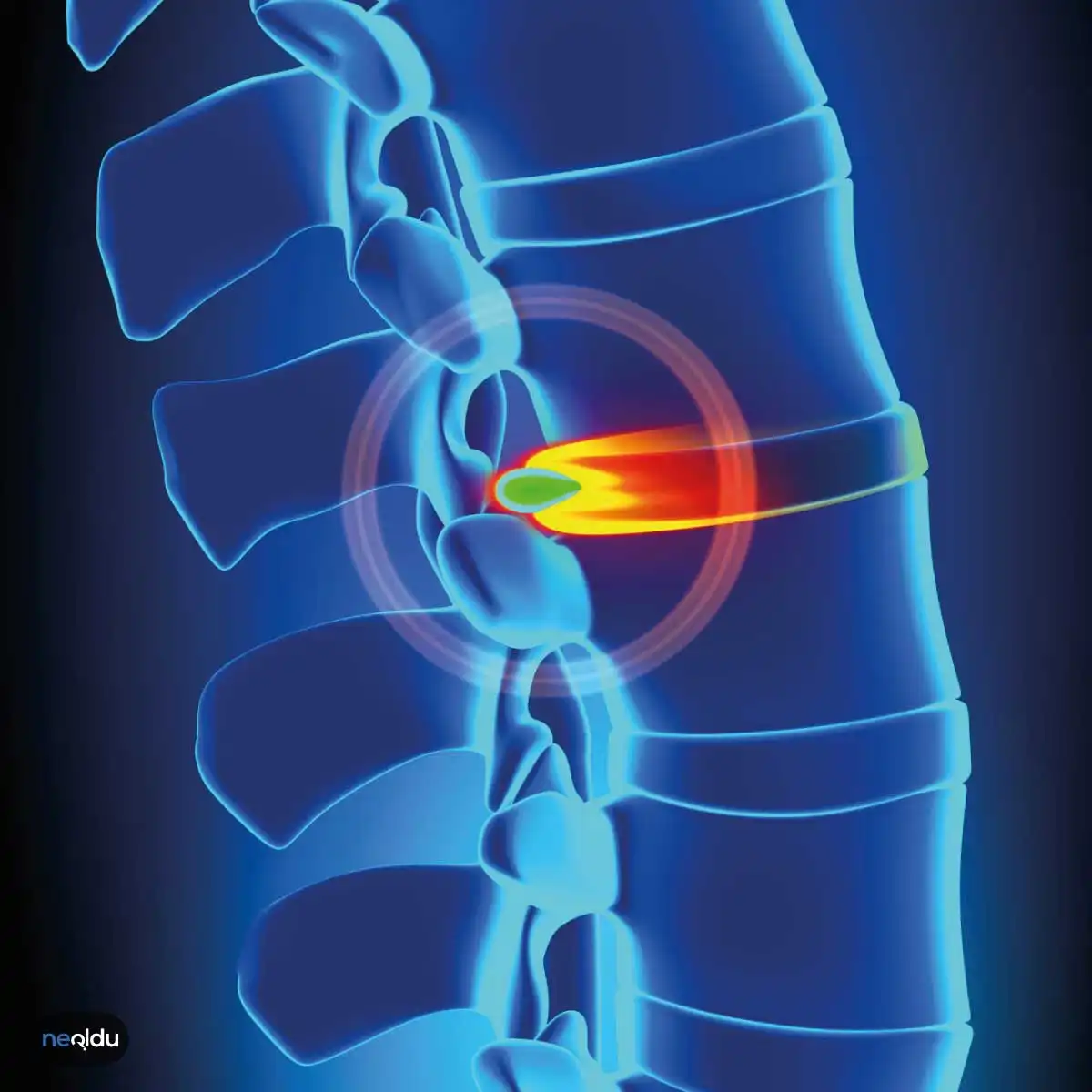 Disk Prolapsı Nedenleri ve Tedavisi