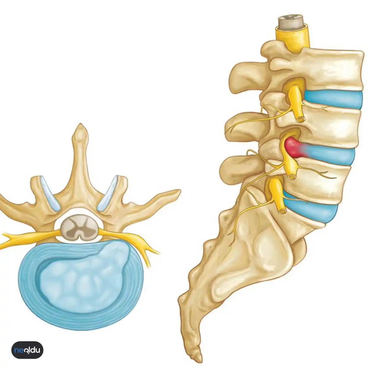  Disk Prolapsı Nedenleri ve Tedavisi