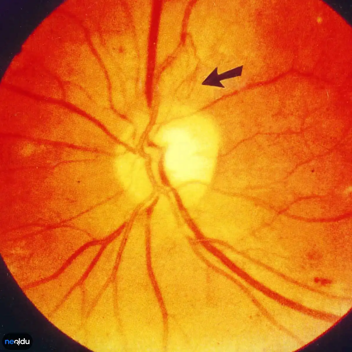 Diyabetik Retinopati Nedir, Belirtileri Nelerdir? Tedavisi