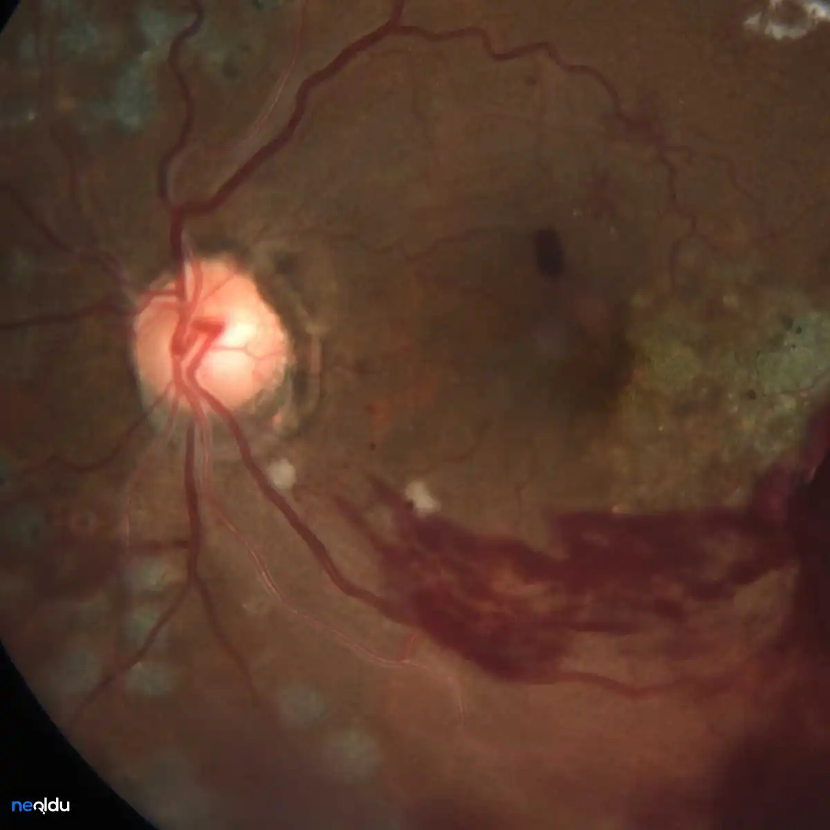 Diyabetik Retinopati Nedir, Belirtileri Nelerdir? Tedavisi