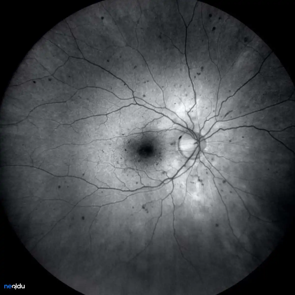 Diyabetik Retinopati Nedir, Belirtileri Nelerdir? Tedavisi