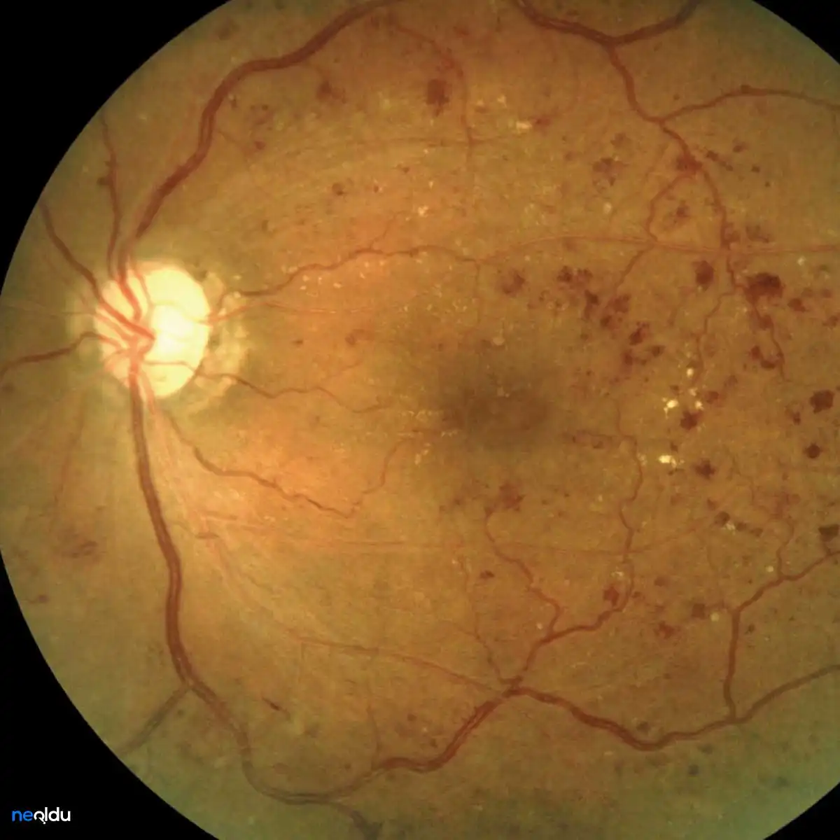 Diyabetik Retinopati Nedir, Belirtileri Nelerdir? Tedavisi