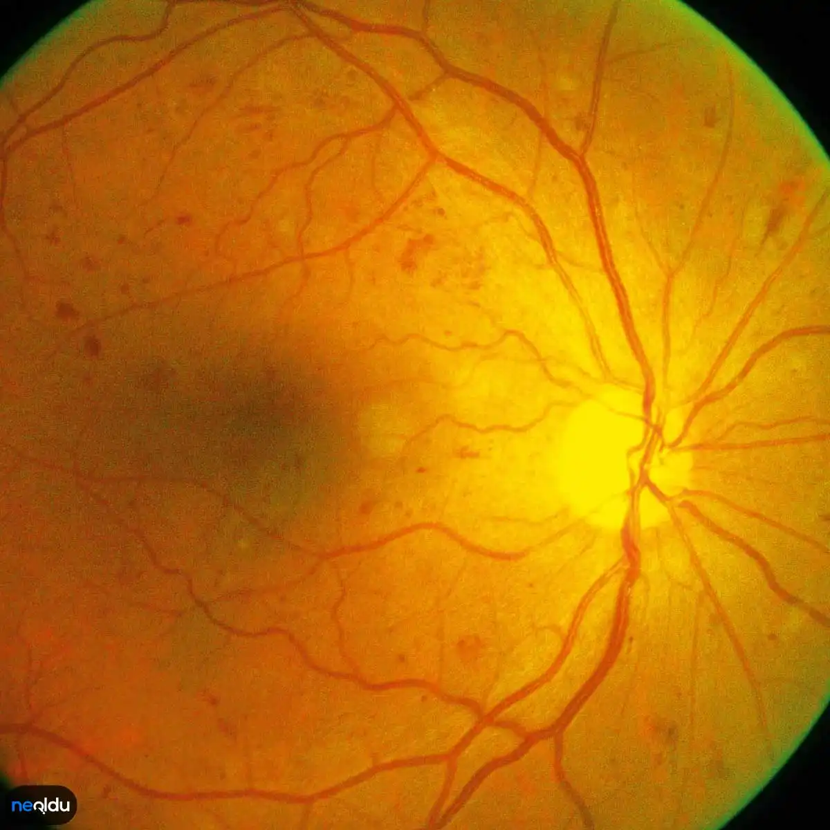 Diyabetik Retinopati Nedir, Belirtileri Nelerdir? Tedavisi