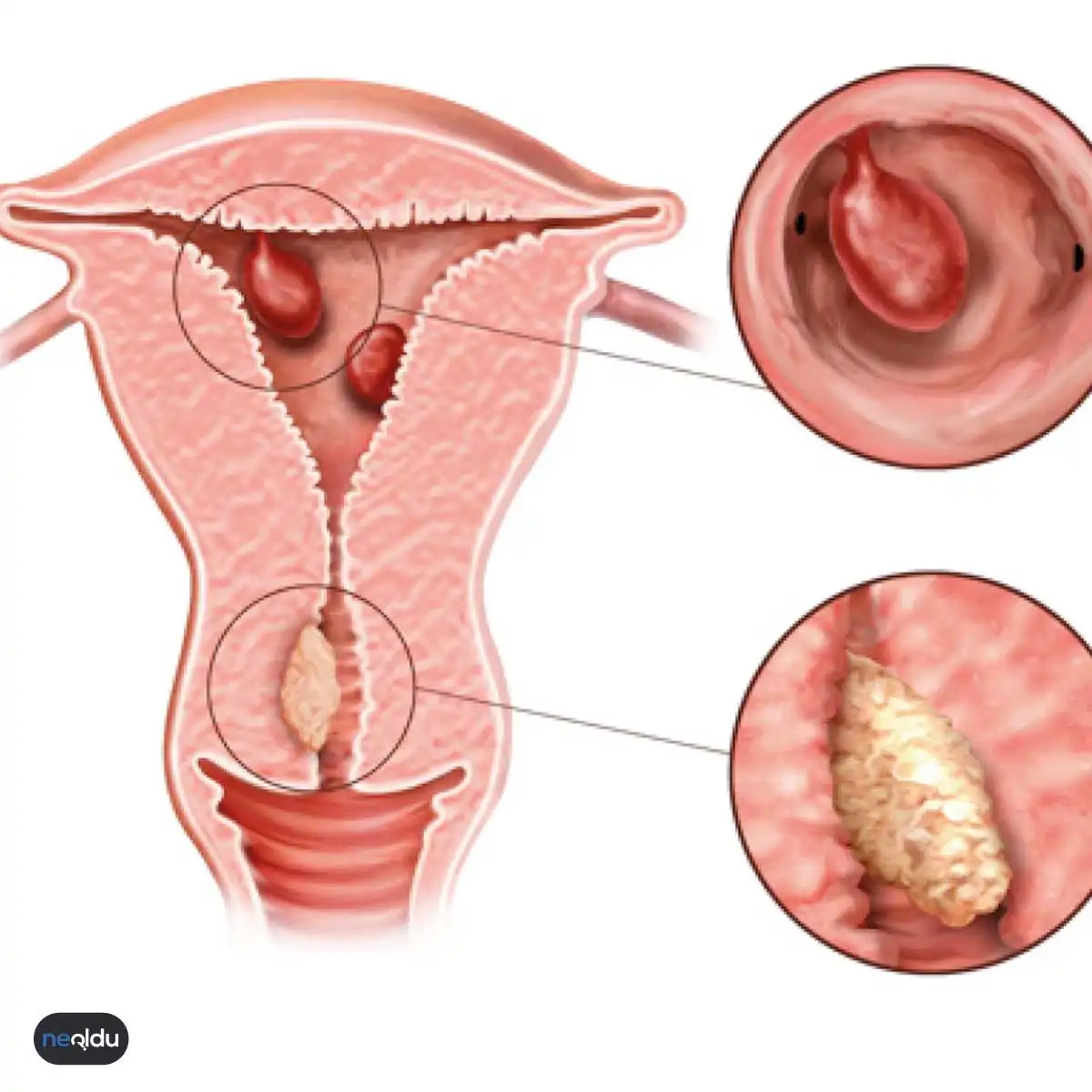 Endometrial Polip