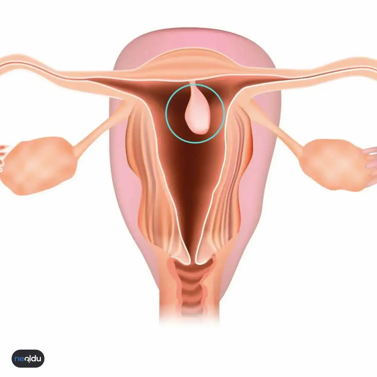 Endometrial Polip