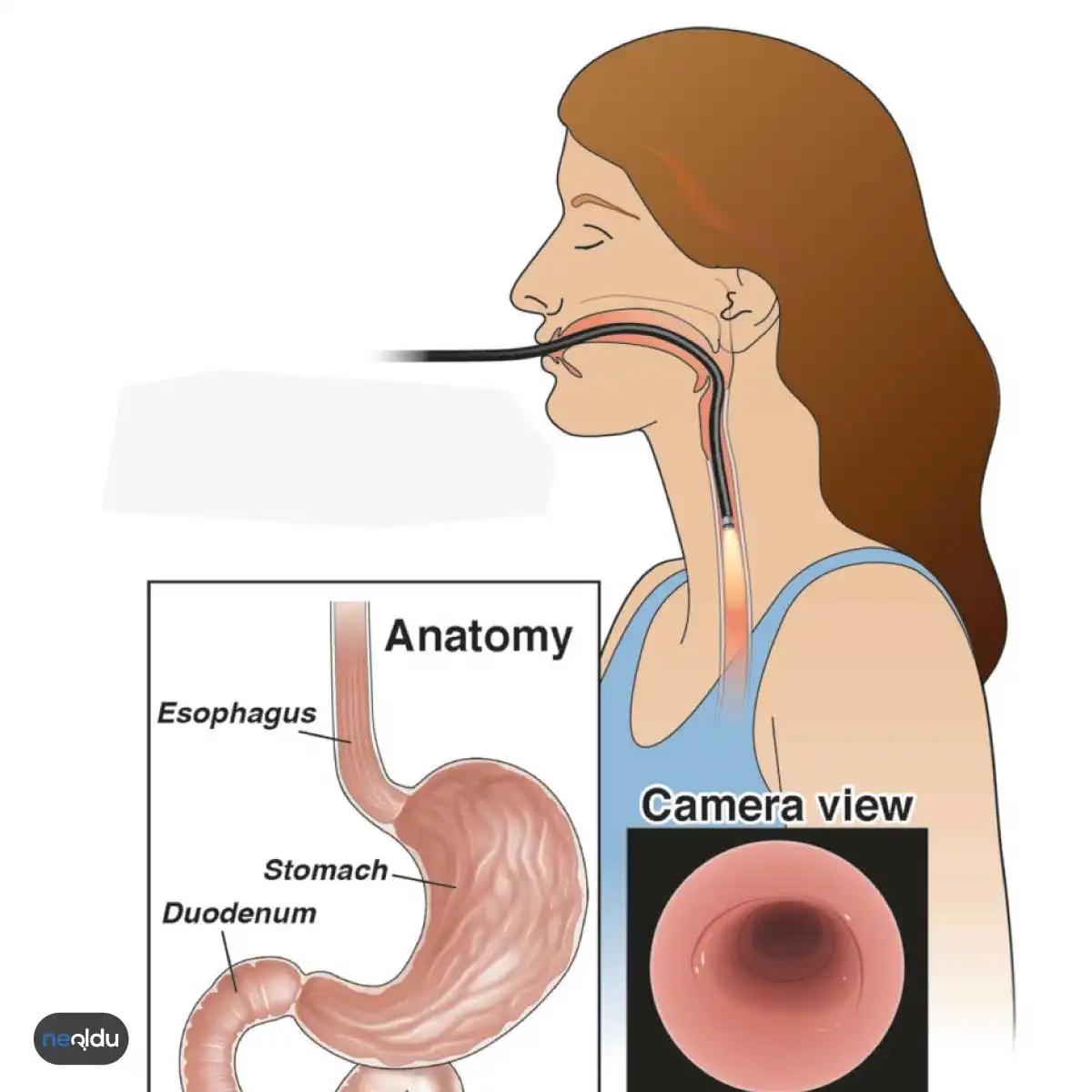 Endoskopi Nedir?