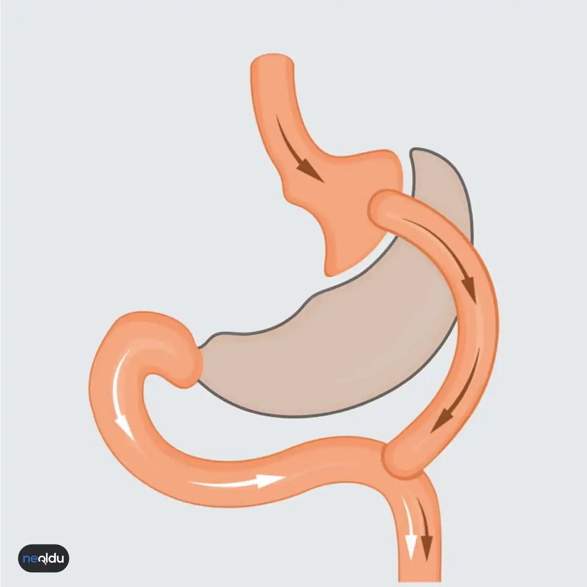 Gastrik Bypass Nedir ve Nasıl Yapılır, Kaç Kilo Verilir?