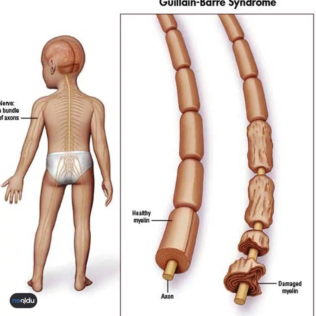 Guillain Barre Sendromu