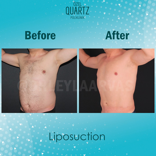 Liposuction - Leyla Arvas