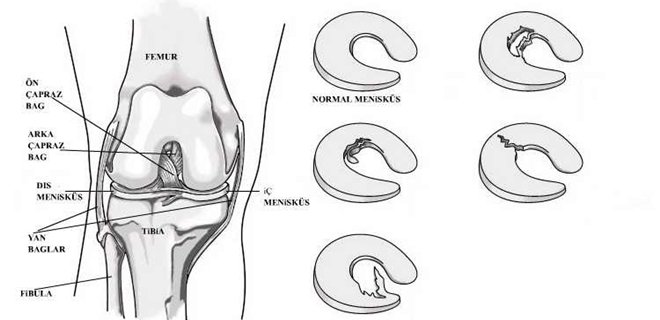 meniskus-yirtik.jpg