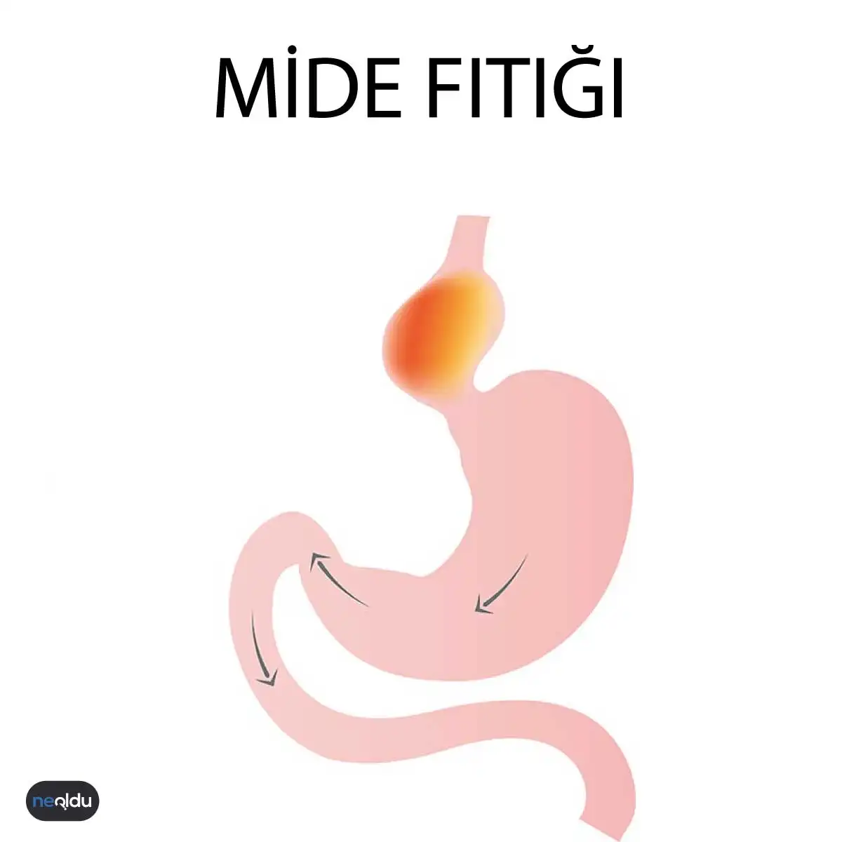 Mide Fıtığı Nedir?