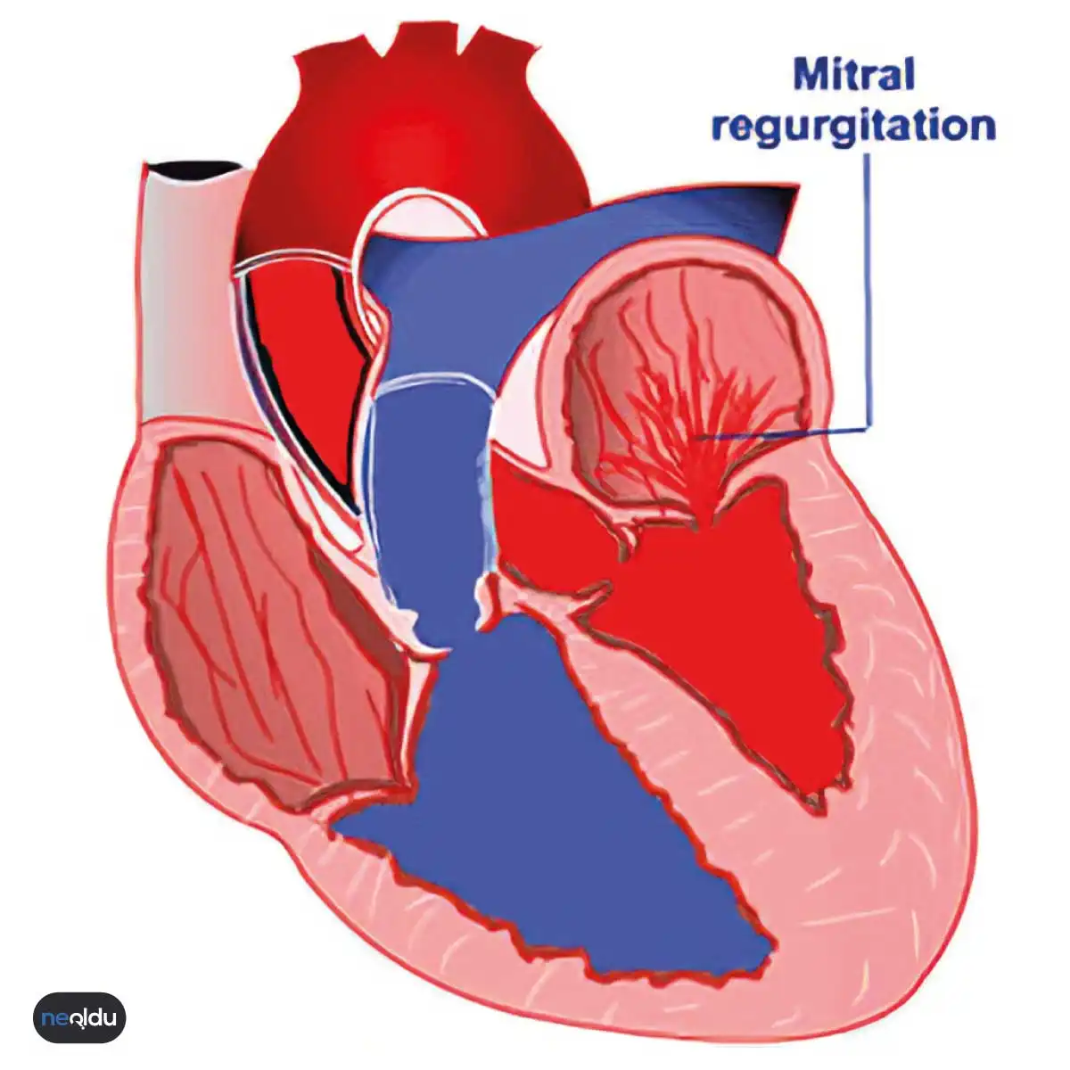 Mitral Kapak Hastalıkları