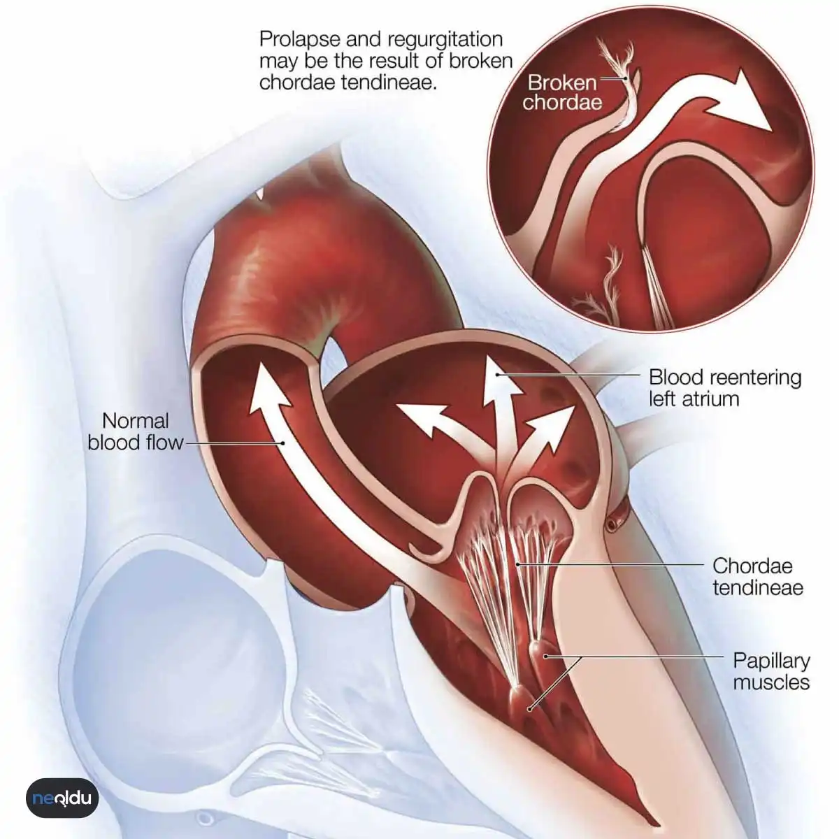 Mitral Kapak Hastalıkları