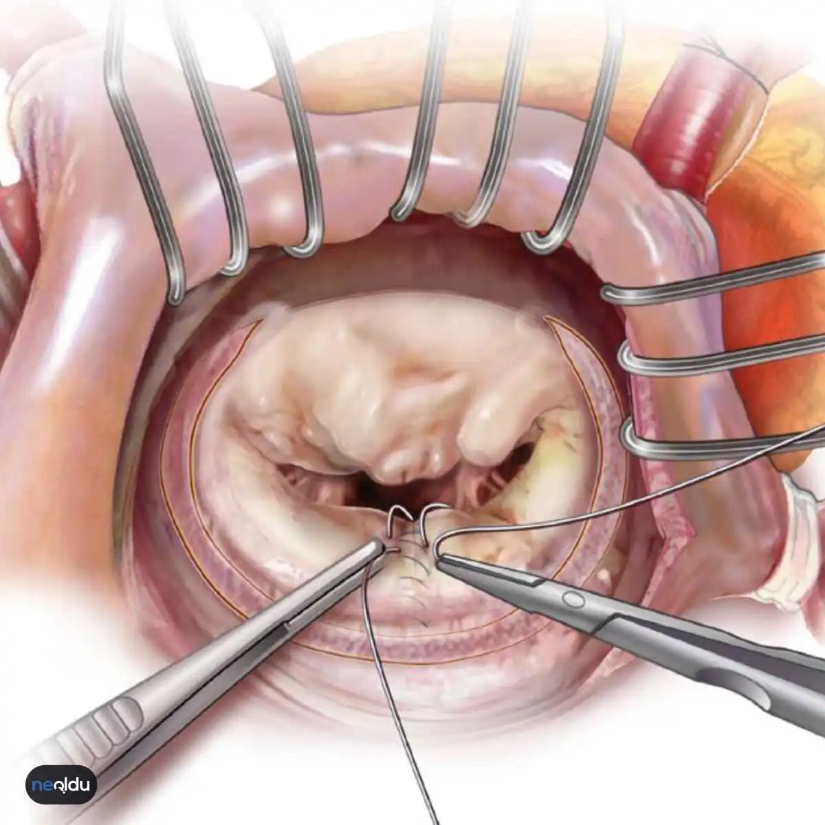 Mitral Kapak Hastalıkları