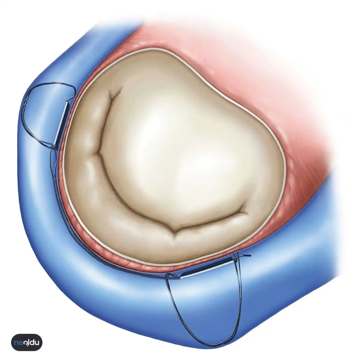 Mitral Kapak Yetmezliği