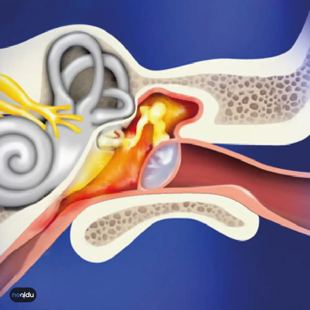 Orta Kulak İltihabı Nedir ve Nasıl Tedavi Edilir?