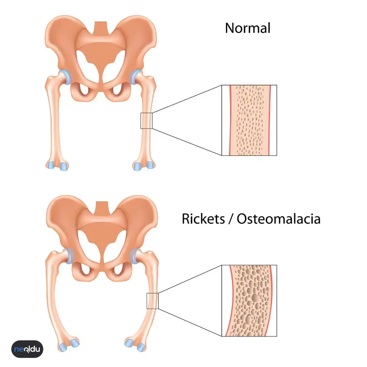 Osteomalazi