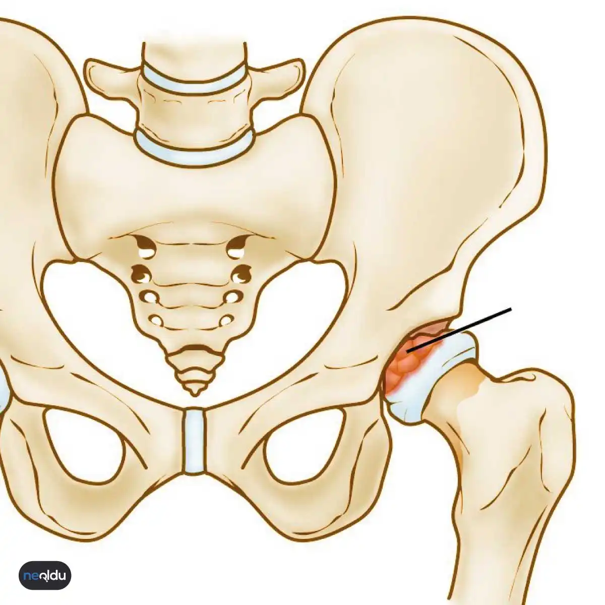 Perthes Hastalığı