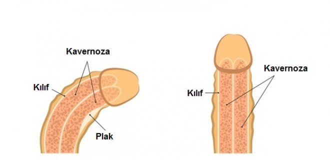 Peyronie hastalığı tedavi yöntemleri