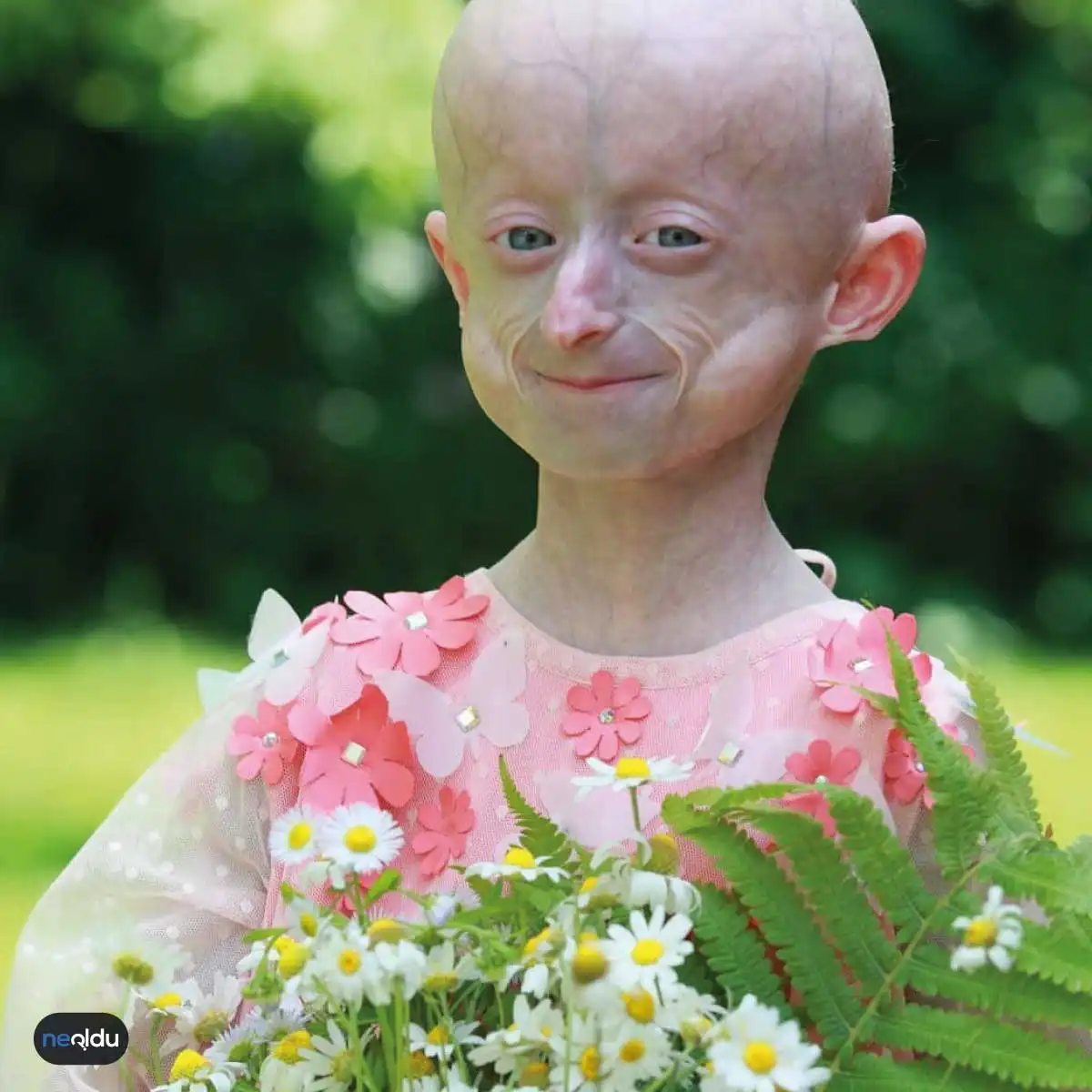 Progeria