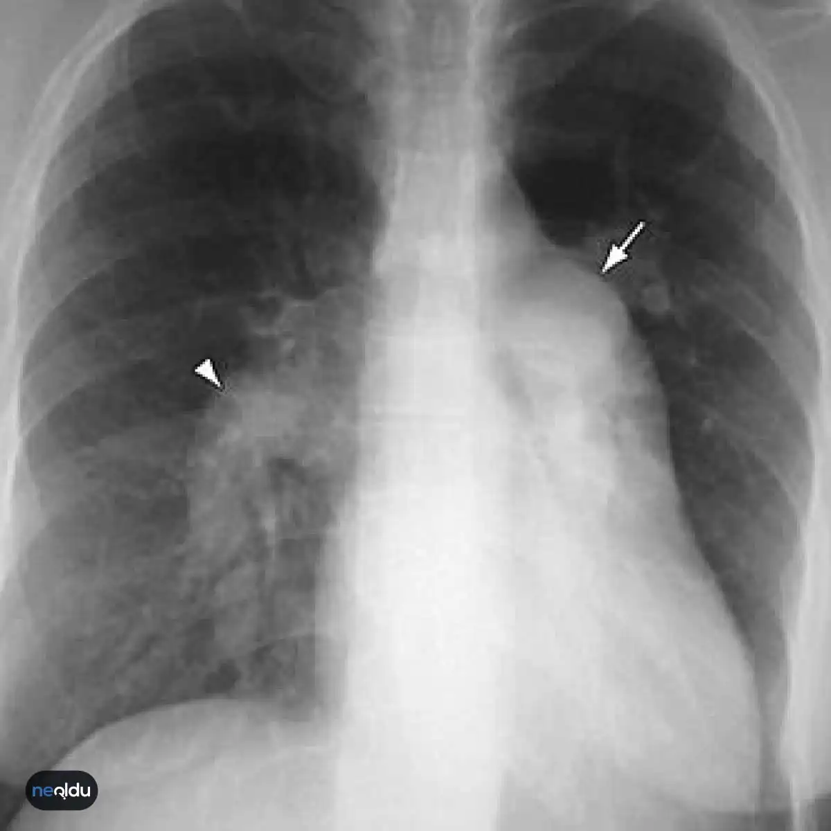 Pulmoner Hipertansiyon