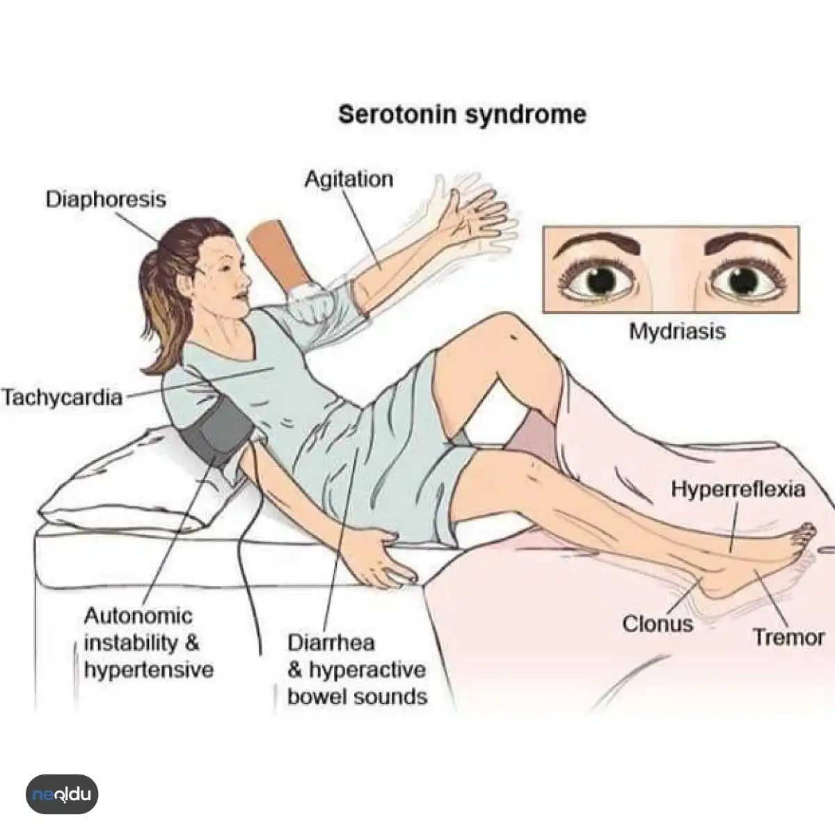 Serotonin Sendromu belirtileri ve semptomlar