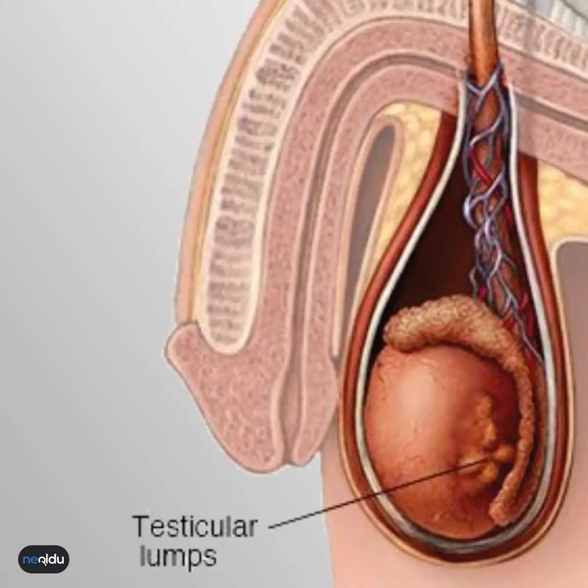 Testis Kanseri
