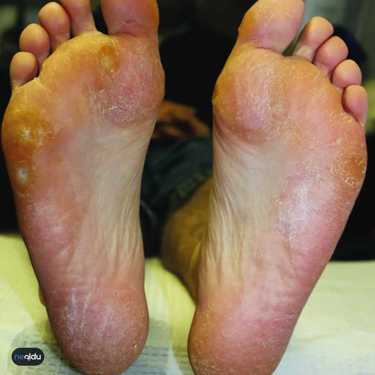 Tinea Pedis