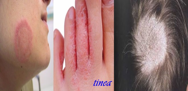 tinea hastalığı