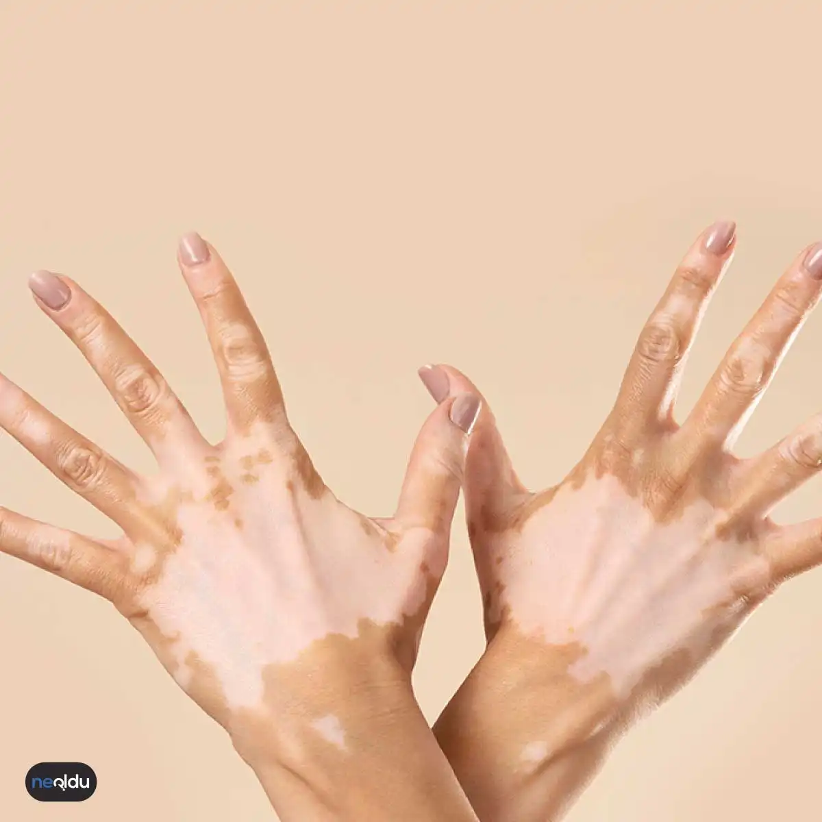 Vitiligo