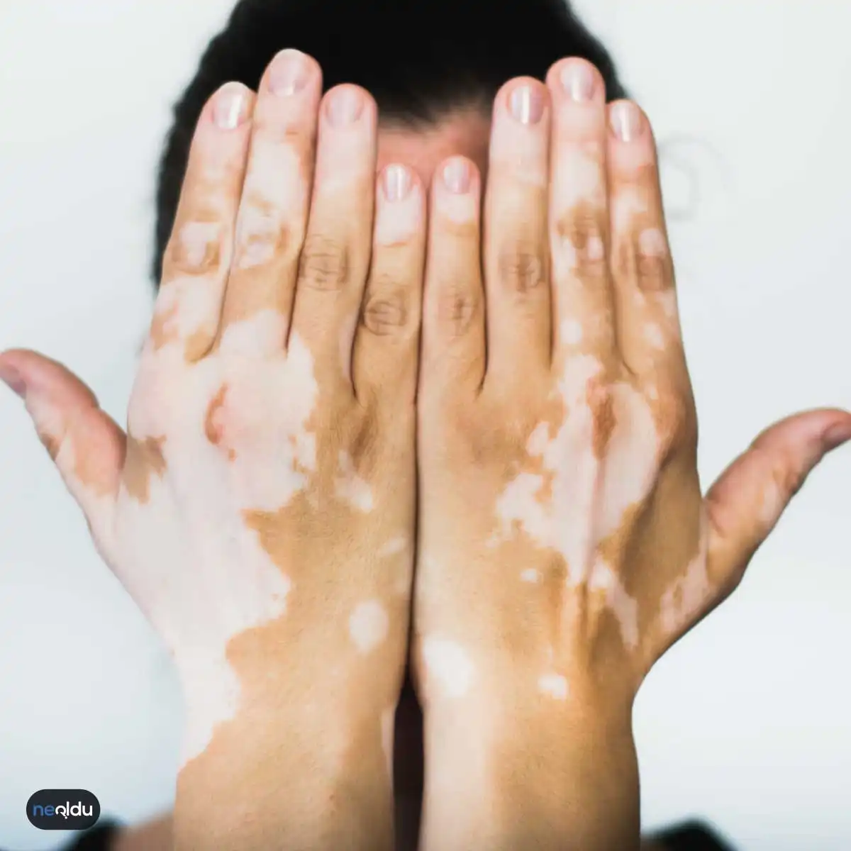 Vitiligo